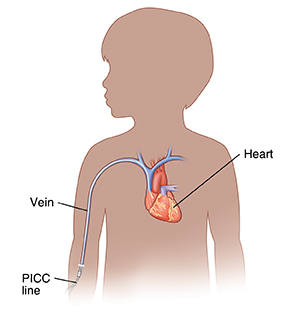 Outline of child showing a PICC line inserted into a vein.