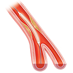 Cross section of artery with balloon catheter inserted.