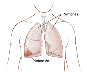 Vista frontal del pecho donde pueden verse los pulmones con infección.