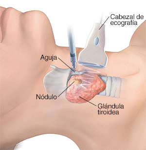 Vista lateral del cuello, donde puede verse la glándula tiroidea con un nódulo. Se ve un cabezal de ecografía sobre la piel, encima de la glándula tiroidea. Se está insertando una aguja a través de la piel hacia el interior del nódulo.
