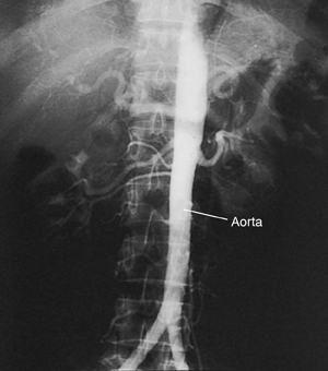 Angiograma de una aorta normal.
