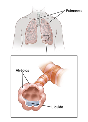 Vista frontal del cuello y el pecho humanos donde pueden verse los pulmones. Un detalle de los pulmones muestra un primer plano del líquido que se está acumulando en los alvéolos.