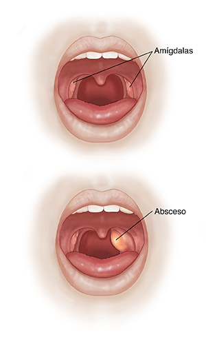 Dos imágenes de una boca abierta que muestran una cavidad bucal normal y un absceso periamigdalino.