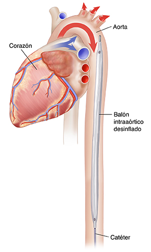 Vista lateral del corazón durante la sístole en la que se observa un balón intraaórtico de contrapulsación desinflado en la aorta