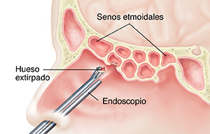 Vista lateral del interior de la nariz en la que se ven los instrumentos que extraen hueso del seno etmoidal.