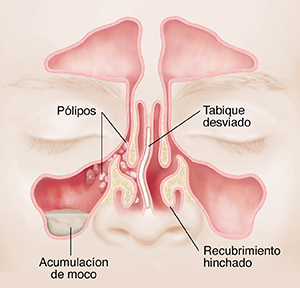 Vista frontal de los senos paranasales donde pueden verse los pólipos, la acumulación de mucosidad, el tabique desviado y el recubrimiento inflamado.