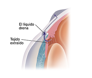 Primer plano del corte transversal de la parte frontal del ojo donde se observa el drenaje de líquido después de una trabeculectomía.
