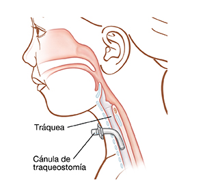 Contorno de la cabeza de un niño que muestra el esófago, la tráquea y la cánula de traqueostomía insertada en el cuello dentro de la tráquea.