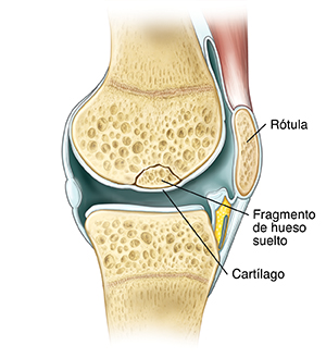 Primer plano de una articulación de rodilla que muestra una pieza suelta de hueso roto del hueso de la pierna pero debajo del cartílago.