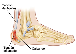 Vista lateral del pie que muestra los huesos del pie y el tendón de Aquiles inflamado.