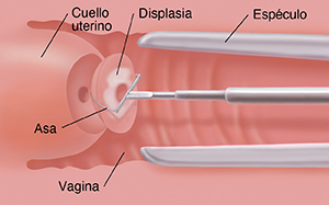 Corte transversal de la vagina y del cuello uterino donde se observa un instrumento con forma de asa con el que se está extirpando la displasia del cuello uterino.