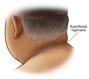 Parte posterior del cuello de un hombre con acantosis pigmentaria.