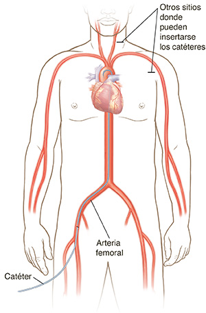 Vista frontal de una figura masculina donde se ve el sistema cardiovascular con un catéter insertado en la arteria femoral hasta el corazón. Se indican otros lugares posibles de inserción de catéteres.
