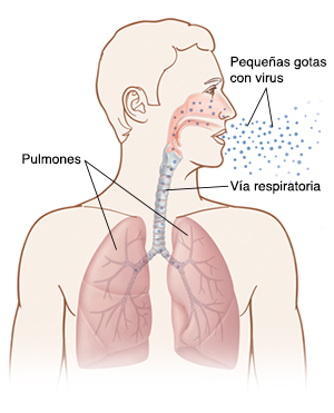 Vista frontal de la cabeza y el tórax de un hombre en la que pueden verse gotitas contaminadas con influenza entrando en los pulmones.