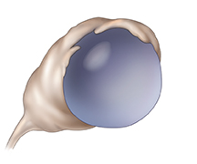 Vista frontal de un ovario con un quiste ovárico.