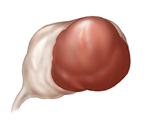 Vista frontal de un ovario con un endometrioma.