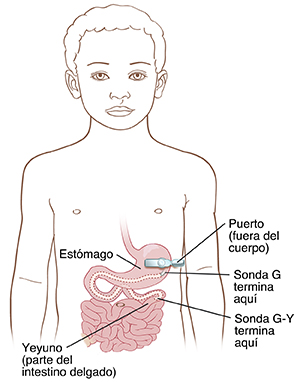 Contorno del abdomen de un niño que muestra el estómago y el intestino delgado. El puerto de la sonda está sobre el abdomen. La sonda está conectada con el puerto y atraviesa la piel. La sonda G desemboca en el estómago, mientras que la sonda G-Y desemboca en el yeyuno (una porción del intestino delgado).