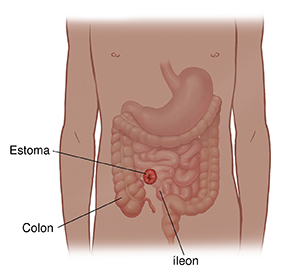 Vista frontal del cuerpo de un niño donde se observa el tubo digestivo y un estoma.