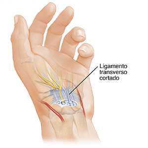 Mano con la palma hacia arriba donde puede verse la anatomía del túnel carpiano y el ligamento cortado.