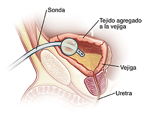 Corte transversal visto de lado de la pelvis de un niño donde pueden verse la vejiga y la uretra. Catéter insertado a través de la piel por encima del hueso de la pelvis, que está drenando orina de la vejiga.