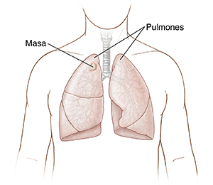 Vista frontal del pecho donde pueden verse los pulmones con una masa en el pulmón derecho.