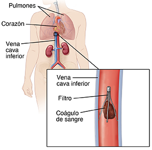 Corte transversal de la vena cava inferior con un filtro colocado para atrapar un coágulo sanguíneo. El localizador muestra un contorno del cuerpo con un recuadro para indicar la ubicación del filtro en la vena cava inferior.