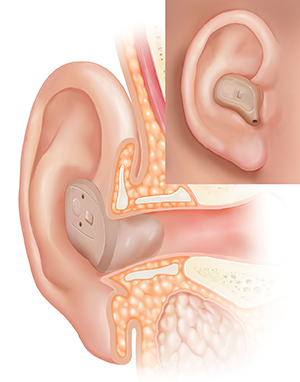 Corte transversal de un oído, donde pueden verse las estructuras del oído externo, interno y medio, con un audífono colocado en el oído y un recuadro que muestra la vista externa.
