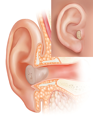 Corte transversal de un oído, donde pueden verse las estructuras del oído externo, interno y medio, con un audífono colocado en el conducto auditivo y un recuadro que muestra la vista externa.
