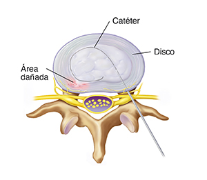 Vista superior de las vértebras lumbares y el disco donde se observa una aguja introduciendo un catéter en el disco.