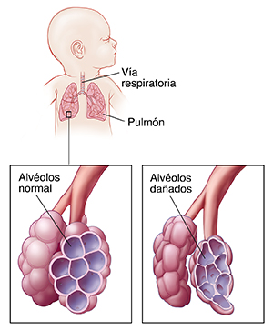 Un bebé con la cabeza hacia un lado en el que se ven las vías respiratorias y los pulmones. Primer plano de las vías respiratorias y los alvéolos normales. Primer plano de las vías respiratorias y los alvéolos dañados.