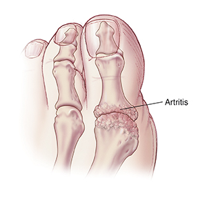 Vista superior de un dedo gordo del pie con artritis.