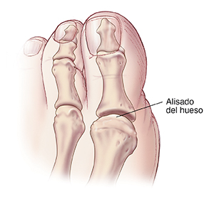 Vista superior de un dedo gordo del pie donde se ve la articulación después del alisado del hueso.