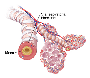 Bronquiolos y alvéolos con acumulación de mucosidad e inflamación debido a la bronquitis crónica.