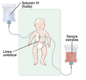 Bebé con vía intravenosa (IV) colocada en el ombligo. La vía está conectada a una bolsa con una solución (líquido) intravenosa. Otra parte de la vía intravenosa está conectada a la bolsa que contiene la sangre extraída.