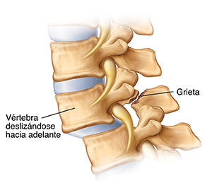 Vista lateral de vértebras con espondilolistesis que muestra las vértebras que se deslizan hacia adelante y causan una rotura en la parte trasera de una vértebra.