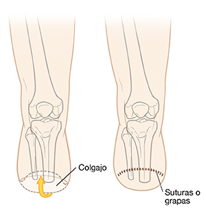 Vista frontal de una pierna donde se observan dos pasos en la amputación de una pierna por debajo de la rodilla con un colgado piel colocado desde atrás y suturado hacia el frente.