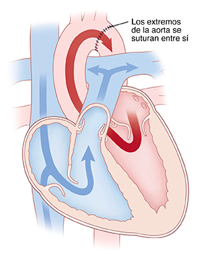 Corte transversal de un corazón donde puede verse la reparación de la coartación de la aorta.