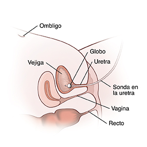 Corte transversal lateral de la parte inferior de un abdomen femenino en donde se ven el ombligo, la vejiga, la uretra, la vagina y el recto. Se inserta un catéter a través de la uretra hacia adentro de la vejiga. Un balón ubicado en la vejiga lo mantiene en su lugar.