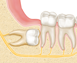 Dientes vistos en corte transversal de una mandíbula. La muela de juicio está en el hueso debajo de la encía, apuntando hacia las raíces del diente de al lado.