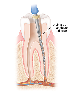 Corte transversal de un diente donde se observa la lima insertada en el conducto radicular.