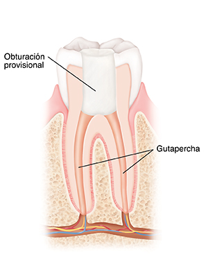 Corte transversal de un diente donde se observa la obturación temporal después del tratamiento de conducto.