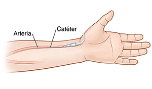 Vista frontal de la palma de la mano y el antebrazo en la que se ve una vía en la arteria radial.