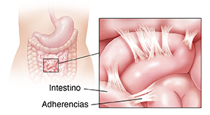 Contorno del cuerpo de una mujer donde se observan el estómago y los intestinos. El recuadro muestra las adherencias.