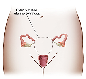 Vista frontal de una pelvis femenina mostrando los órganos reproductores. Una línea punteada delinea el útero y el cuello uterino para mostrar una histerectomía total. 