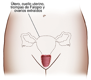 Vista frontal de una pelvis femenina mostrando los órganos reproductores. Un línea punteada delineando el útero, el cuello uterino, las trompas de Falopio y los ovarios indican una histerectomía y ovarios extraídos.