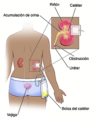 Vista posterior de una persona en donde se observan las vías urinarias con una sonda de nefrostomía y una bolsa del catéter. En el recuadro, se observan un primero plano de un riñón con una obstrucción y una sonda de nefrostomía.