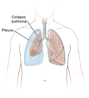Contorno de un hombre que muestra un pulmón colapsado dentro de la pleura del lado derecho. Se ve un pulmón normal a la izquierda. 
